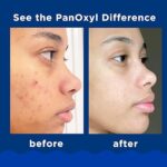 PanOxyl Acne Foaming Wash 10% Benzoyl Peroxide Maximum Strength Strength 156g - Image 2