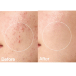 ANUA BHA 2% Gentle Exfoliating Toner 150ml - Image 4